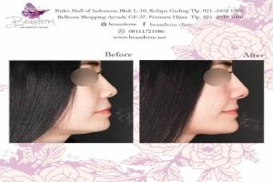 Filler Hidung / Nose Filler